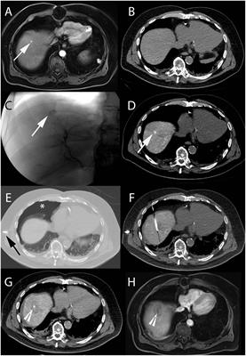 Theranostics in Interventional Oncology: Versatile Carriers for Diagnosis and Targeted Image-Guided Minimally Invasive Procedures